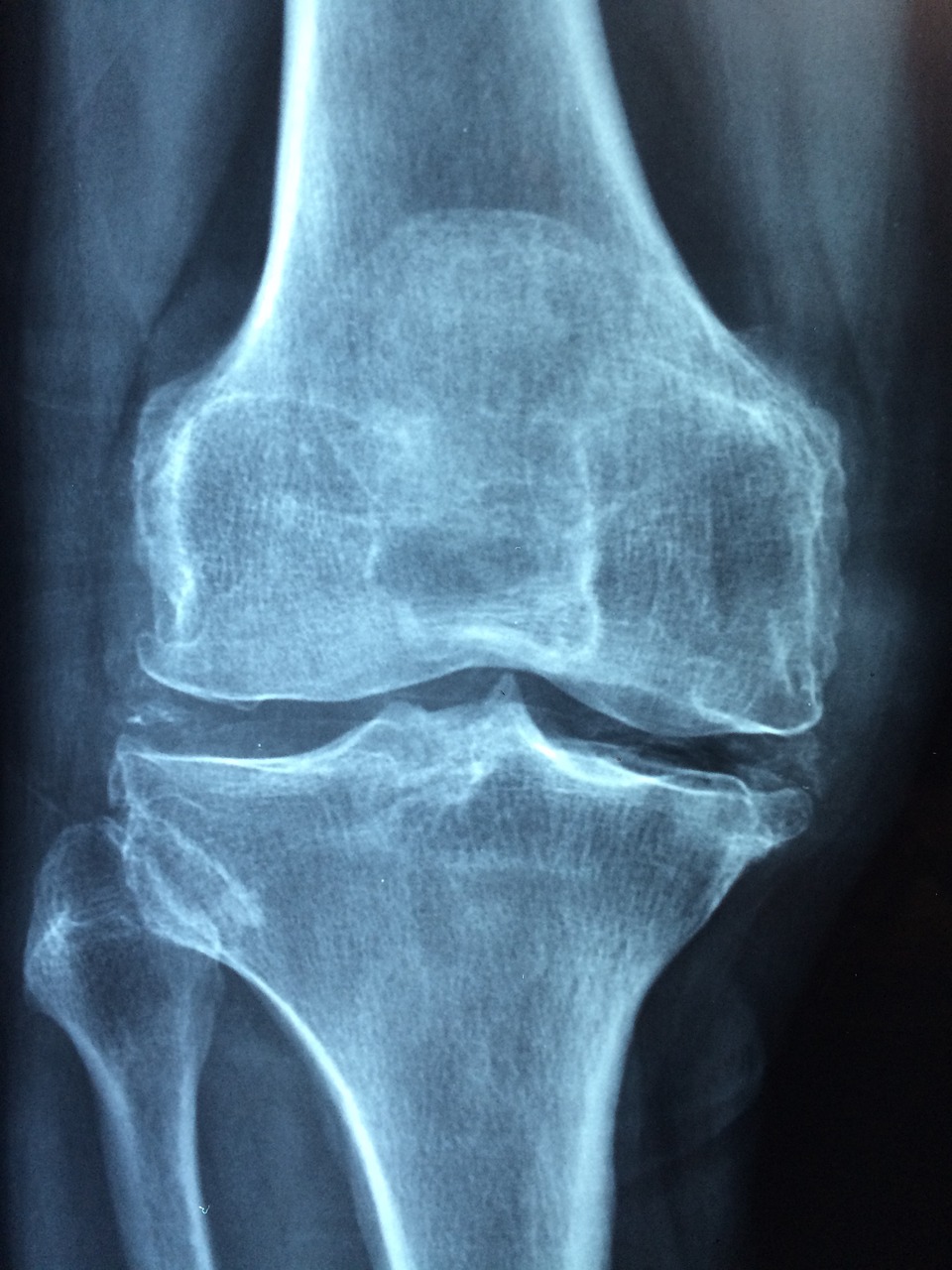 artroskopia kolana warszawa